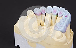 wax denture
