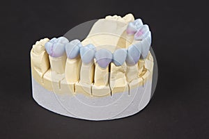 wax denture