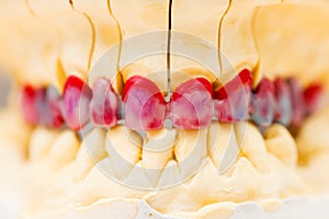 Wax Denture