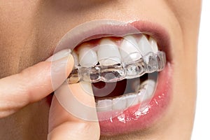 Wearing orthodontic silicone trainer photo