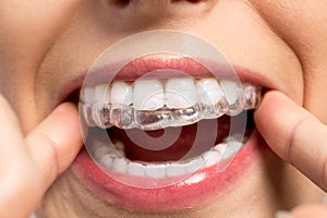 Wearing orthodontic silicone trainer photo