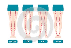 Difference types of legs angles and knees vector illustration . Normal, Bowlegs, Knock-knees.