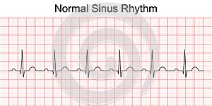 Electrocardiogram show normal heart beat line Sinus rhythm.