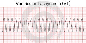 Electrocardiogram show monomorphic ventricular tachycardia VT. photo