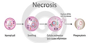 Necrosis, Pathologic Cell Death.