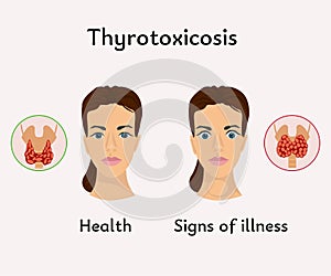 thyrotoxicosis thyroid gland medical poster photo