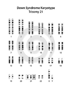 Down syndrome (trisomy 21) human karyotype