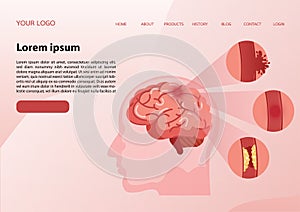 Web banner design template.Stroke disease