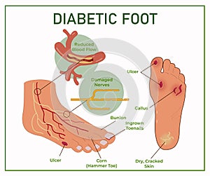 Web Diabetic Foot. Diabetes symptoms.