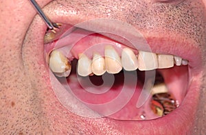 The wedge-shaped defect of the teeth