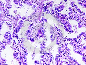 Well differentiated adenocarcinoma of a human