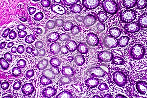 Well-differentiated intestinal adenocarcinoma, light micrograph