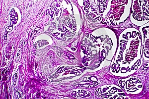 Well-differentiated intestinal adenocarcinoma, light micrograph