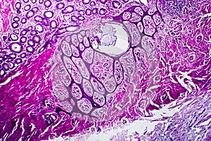 Well-differentiated intestinal adenocarcinoma, light micrograph