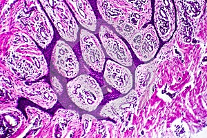 Well-differentiated intestinal adenocarcinoma, light micrograph