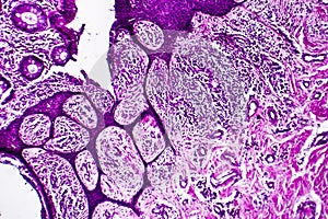 Well-differentiated intestinal adenocarcinoma, light micrograph