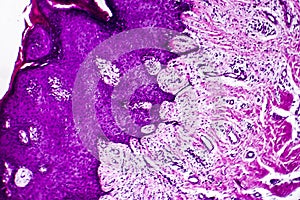 Well-differentiated intestinal adenocarcinoma, light micrograph photo