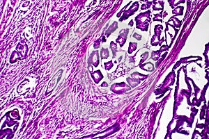 Well-differentiated intestinal adenocarcinoma, light micrograph