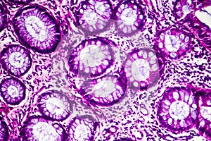 Well-differentiated intestinal adenocarcinoma, light micrograph