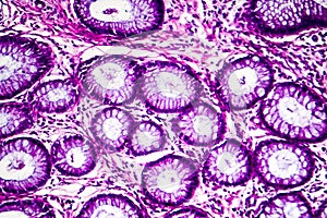 Well-differentiated intestinal adenocarcinoma, light micrograph