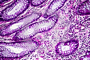 Well-differentiated intestinal adenocarcinoma, light micrograph
