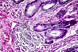 Well-differentiated intestinal adenocarcinoma, light micrograph