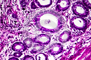 Well-differentiated intestinal adenocarcinoma, light micrograph