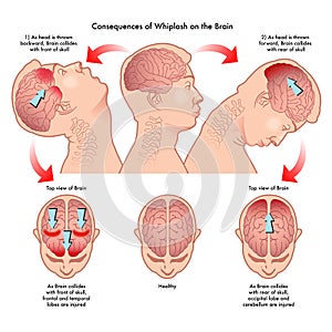 Whiplash and the brain