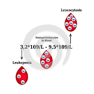 White blood cell count. Leukopenia. Leukocytosis. Infographics. Vector illustration