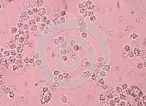 White blood cells in urine