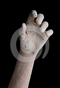 White chapped hand photo
