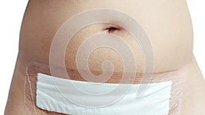 White cloth on woman belly after operate