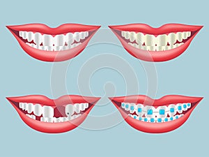 White, dirty, decayed, broken and orthodontics tooth