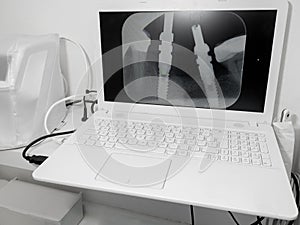 White laptop showing a radiology image of screws of implanted teeth
