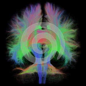 White Matter Tractography of the Human Brain in Coronal View photo