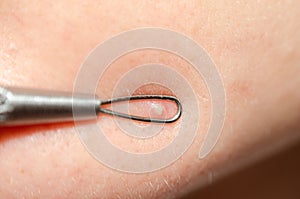 White pimple on the skin of the face with a cosmetic tool loop for cleaning blackheads close-up