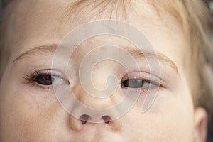 White pimple on the upper eyelid of the eye, milium. Inflammation of the eye of a small baby child, conjunctivitis. Milium is a