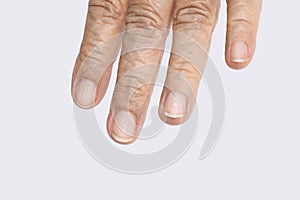 White spots on elderly fingernails