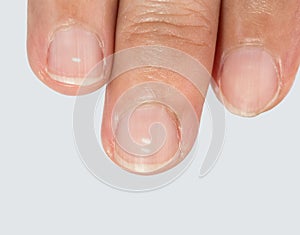 White spots on fingernails.