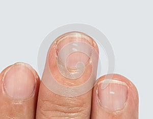 White spots on fingernails photo