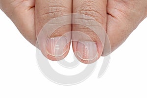 White spots and Vertical ridges on the fingernails