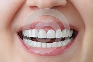 White teeth of a caucasian woman after treatment and whitening of teeth, dental crowns. photo