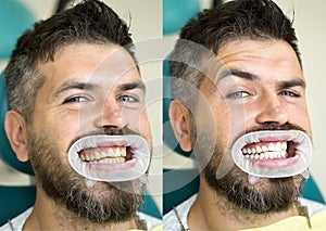 White teeth - before and after concept. Close-up detail of man teeth before and after whitening. Result of teeth