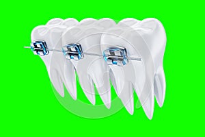 White teeth with metal braces on a blue background. Dental braces, orthodontic treatment, dentistry, teeth whitening, protection,