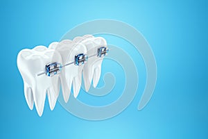 White teeth with metal braces on a blue background. Dental braces, orthodontic treatment, dentistry, teeth whitening, protection,