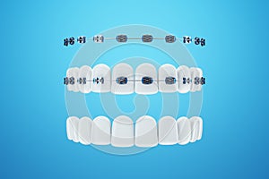 White teeth with metal braces on a blue background. Dental braces, orthodontic treatment, dentistry, teeth whitening, protection,