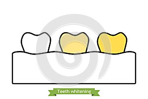 White to yellow tooth, teeth whitening before and after concept