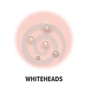 Whiteheads skin acne type vector icon. Skin disease acne whiteheads pimples type and face pore comedones photo