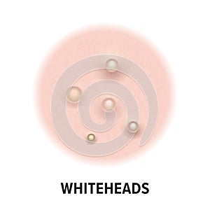 Whiteheads skin acne type vector icon. Skin disease acne whiteheads pimples type and face pore comedones