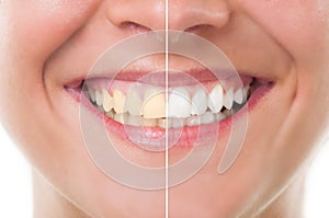 Before and after whitening